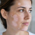 White patches on face: causes, symptoms and treatment options